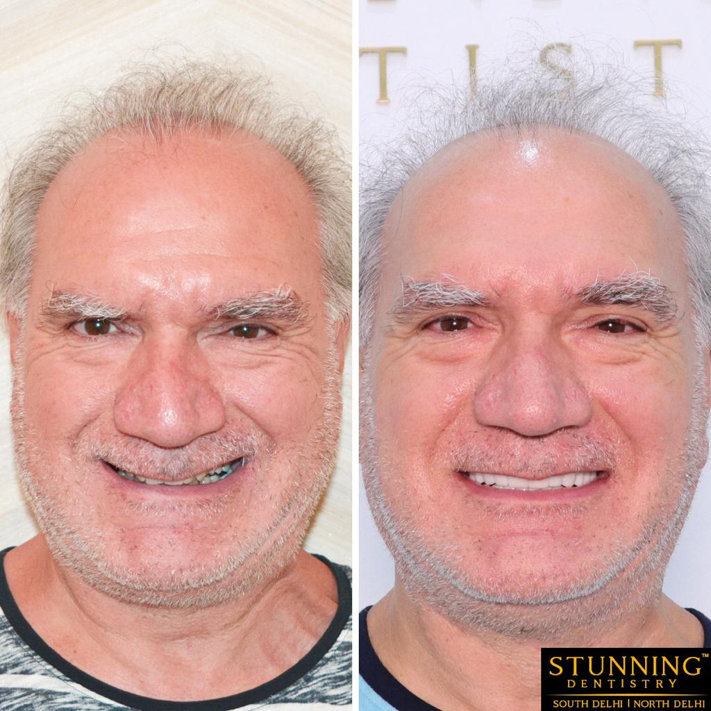 dental implants cases