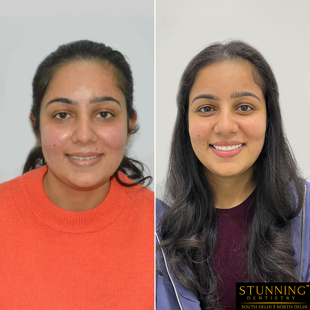 teeth correction results