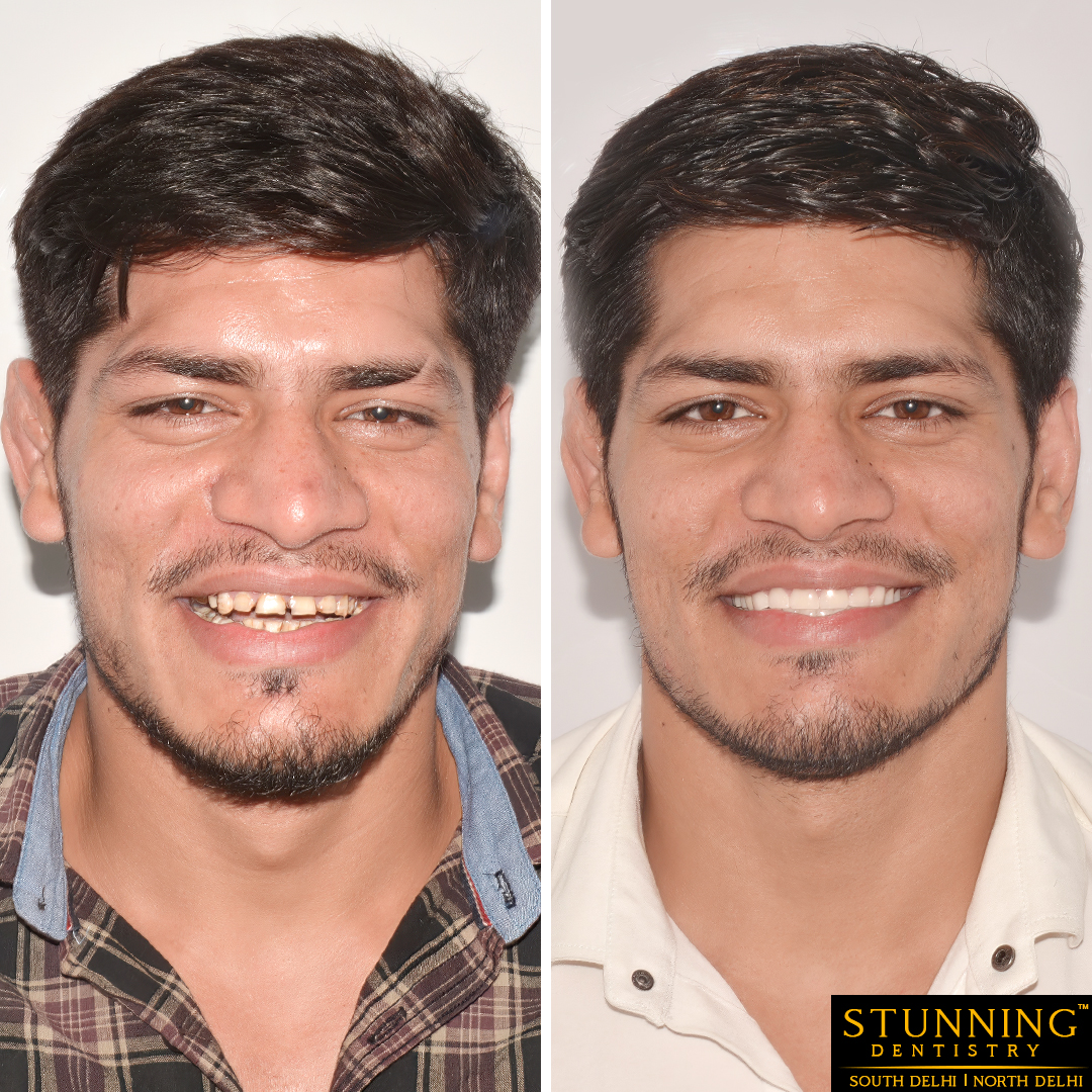 dental implants cases