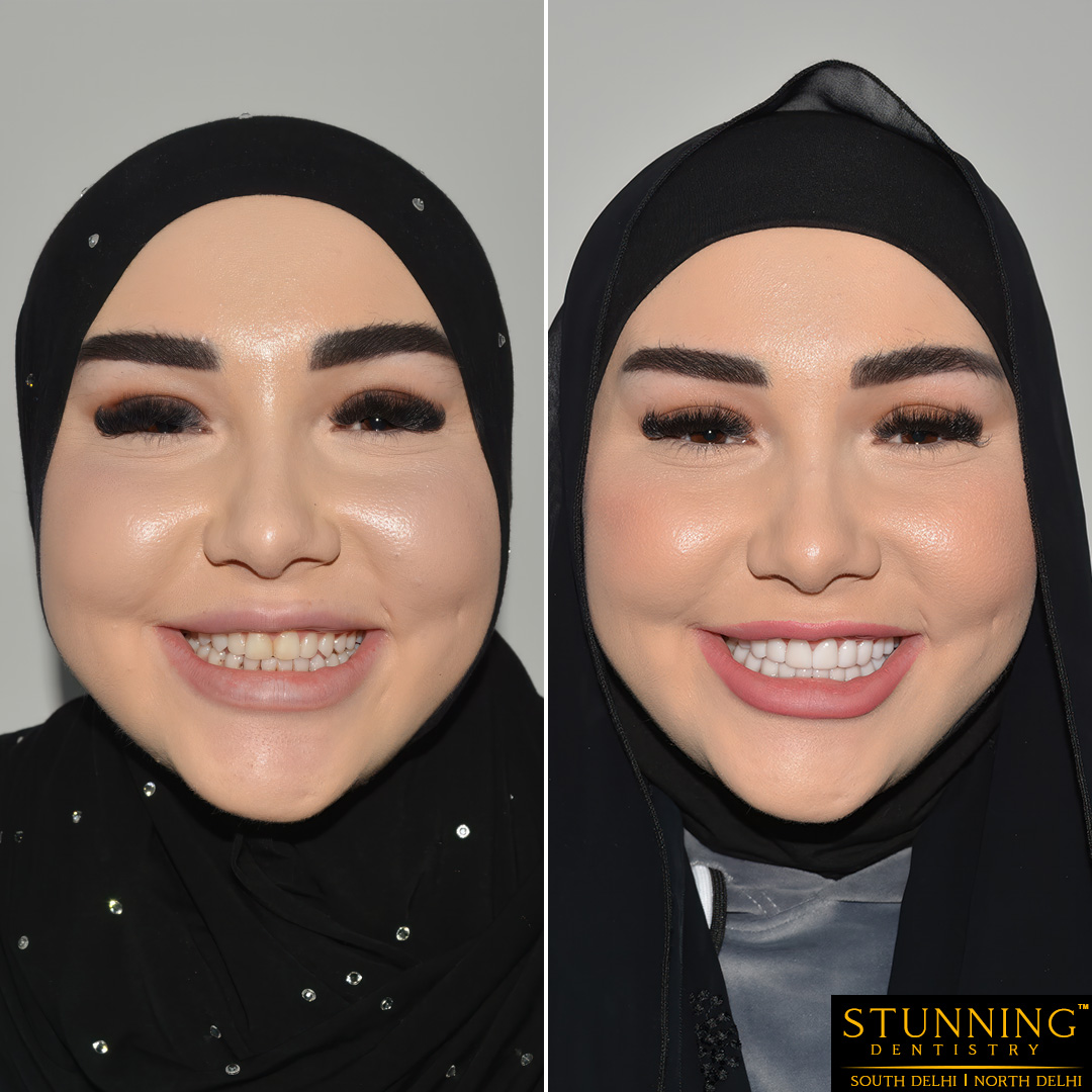 teeth correction results