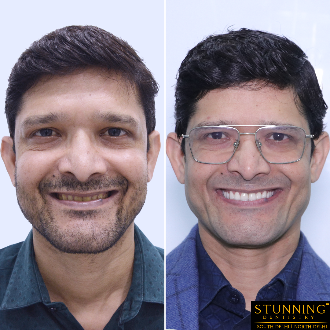 dental implants cases