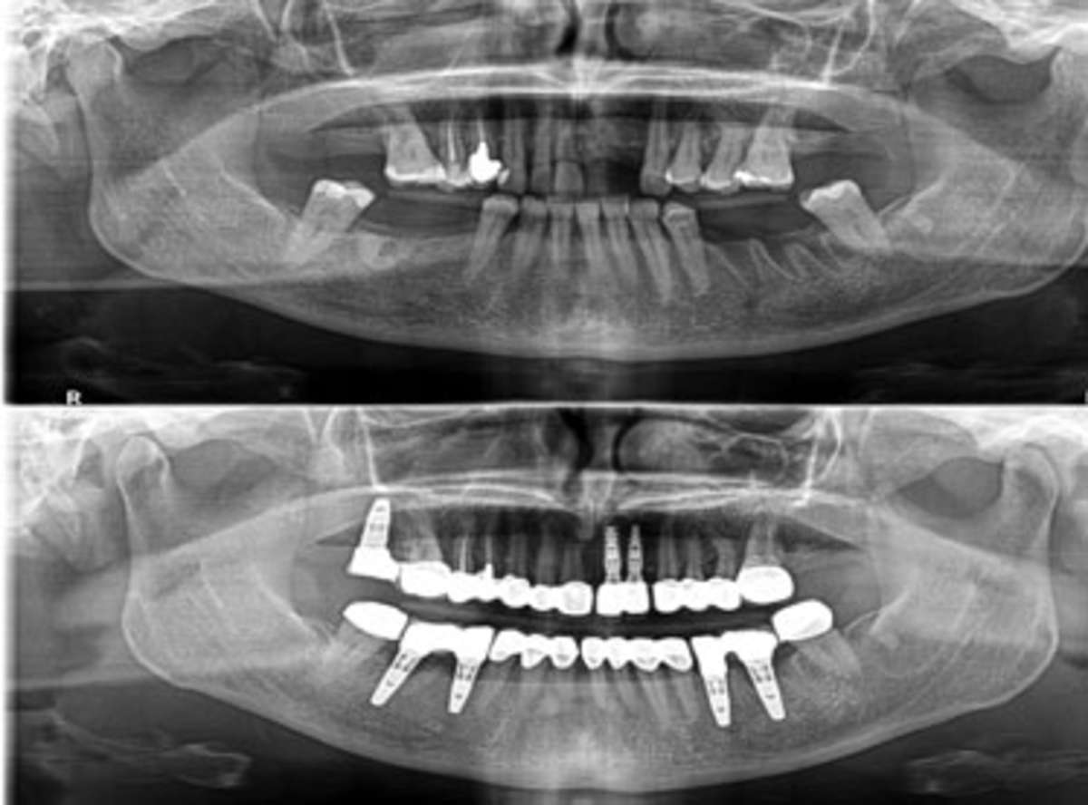Multiple Dental Implants near me