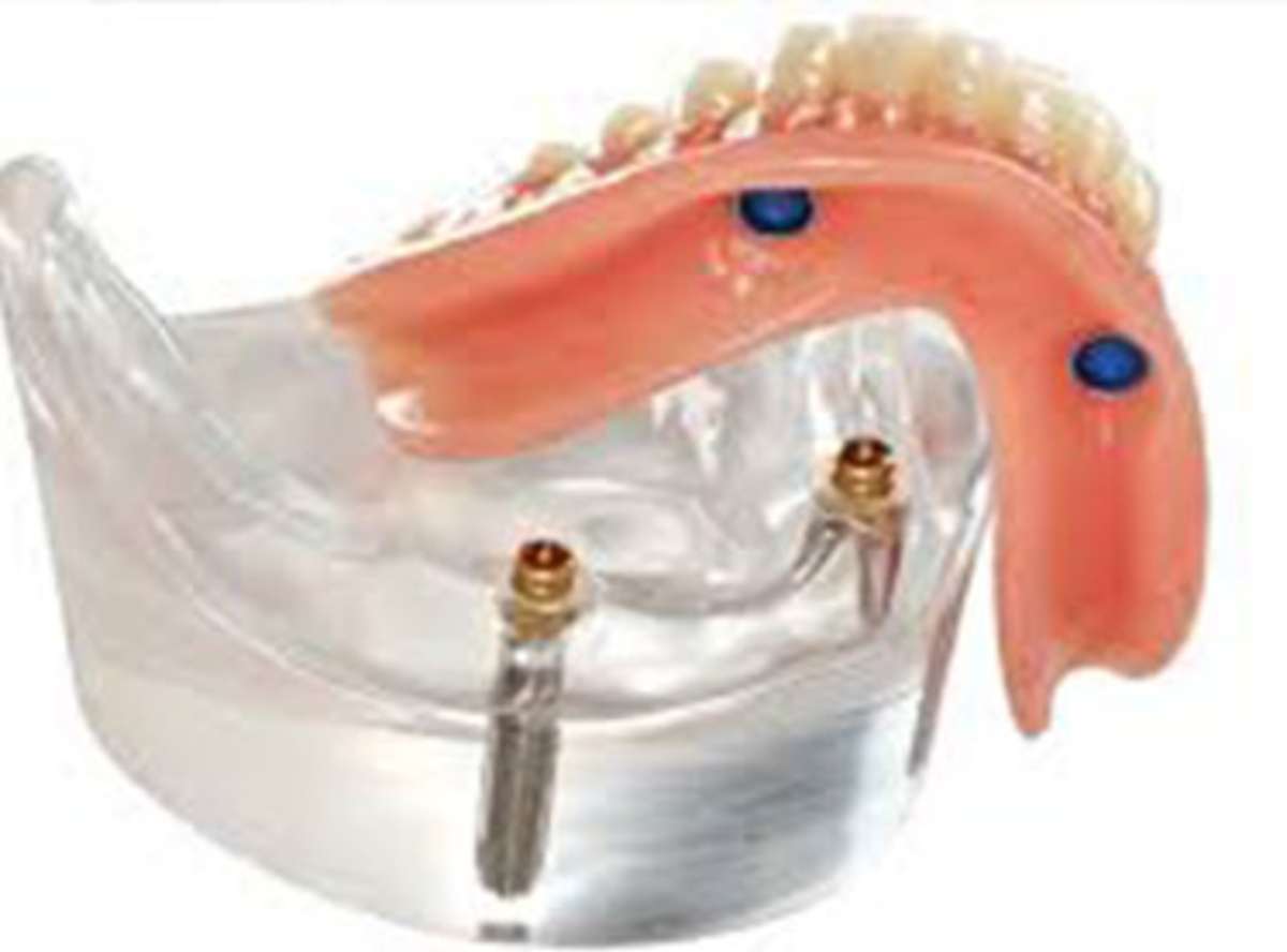 Implant Supported Mandibular Overdenture near me