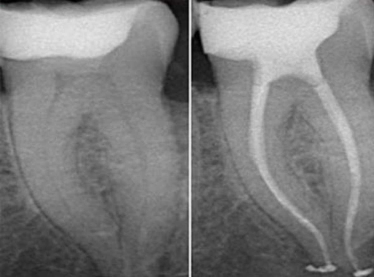 paineless root canal in south delhi, tooth pain treatment