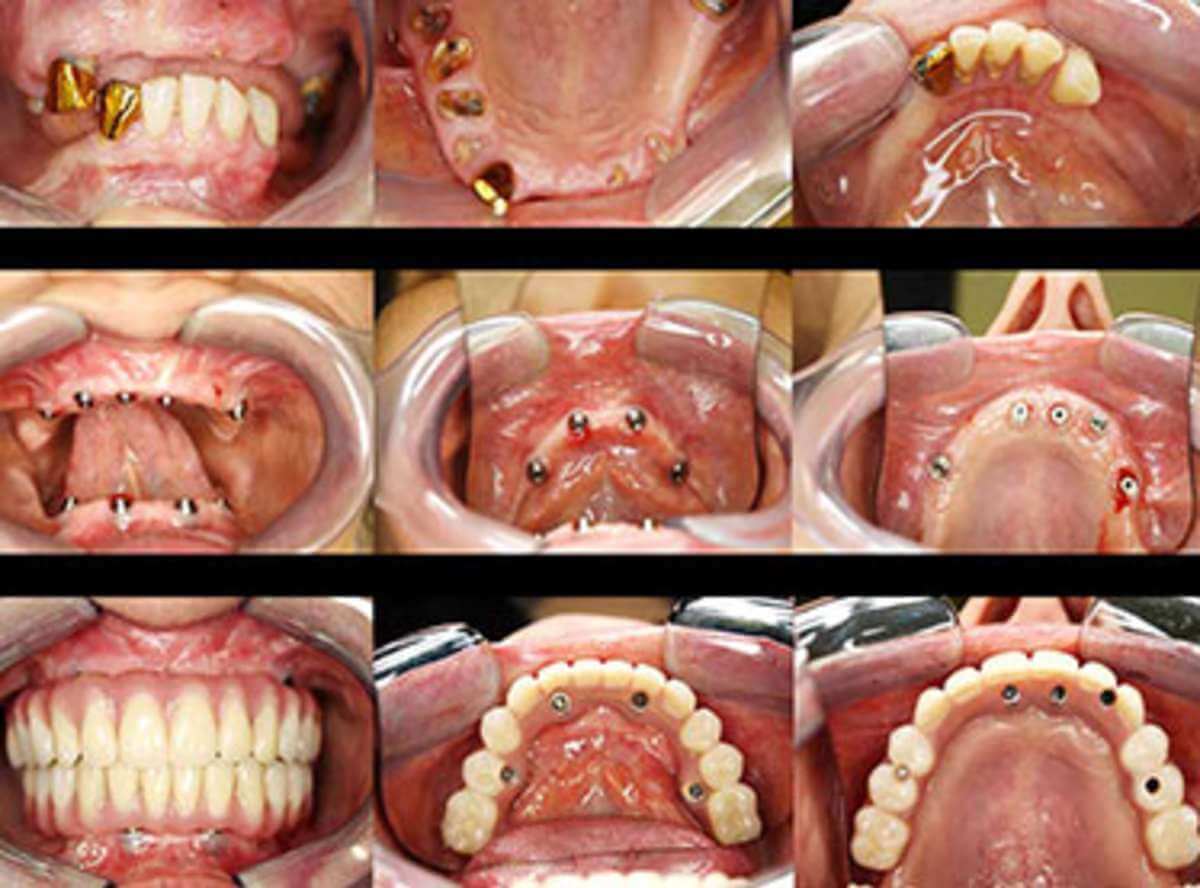Same Day dental Implants