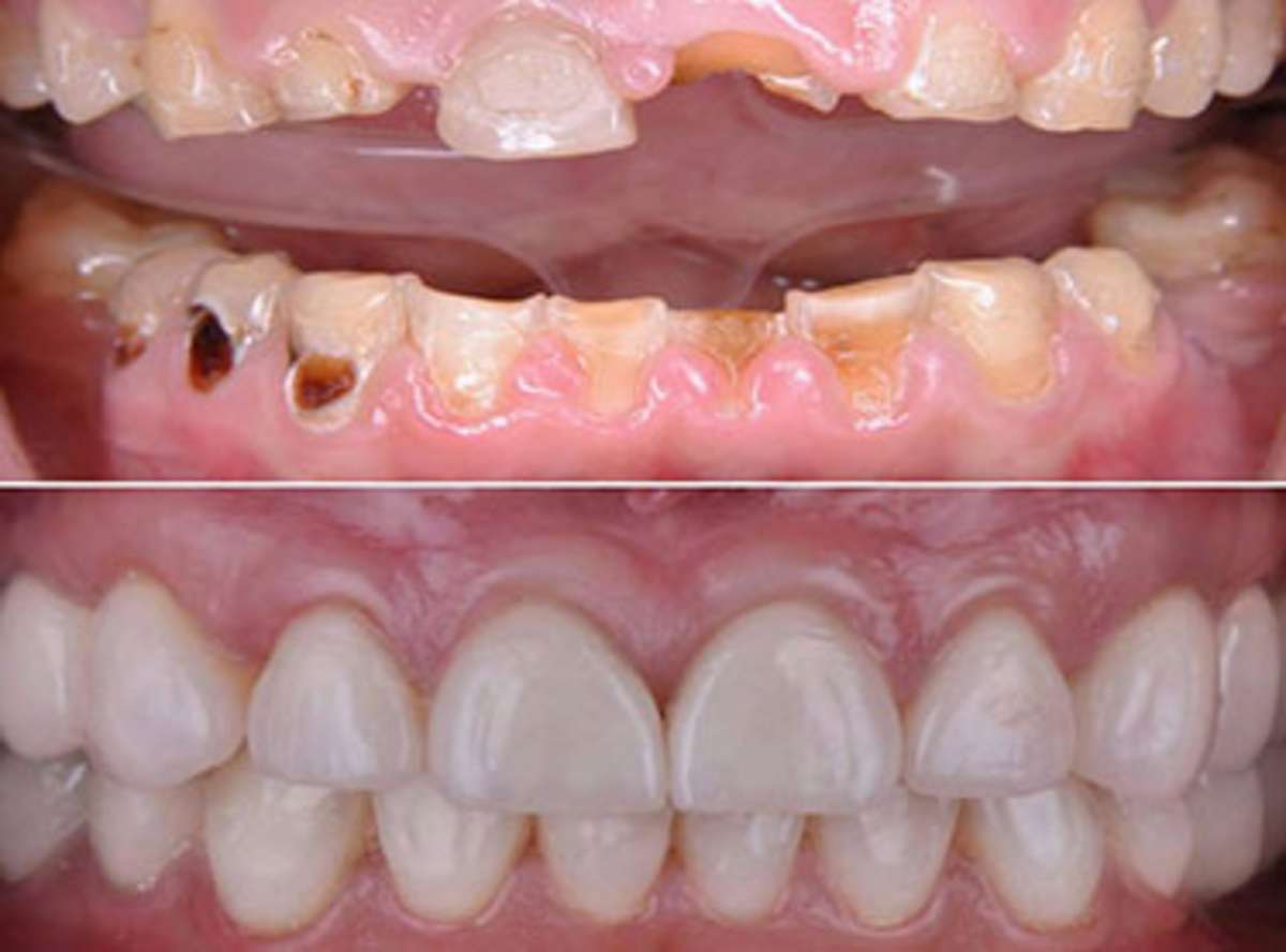 Tooth Decay/Cavity treatment near me