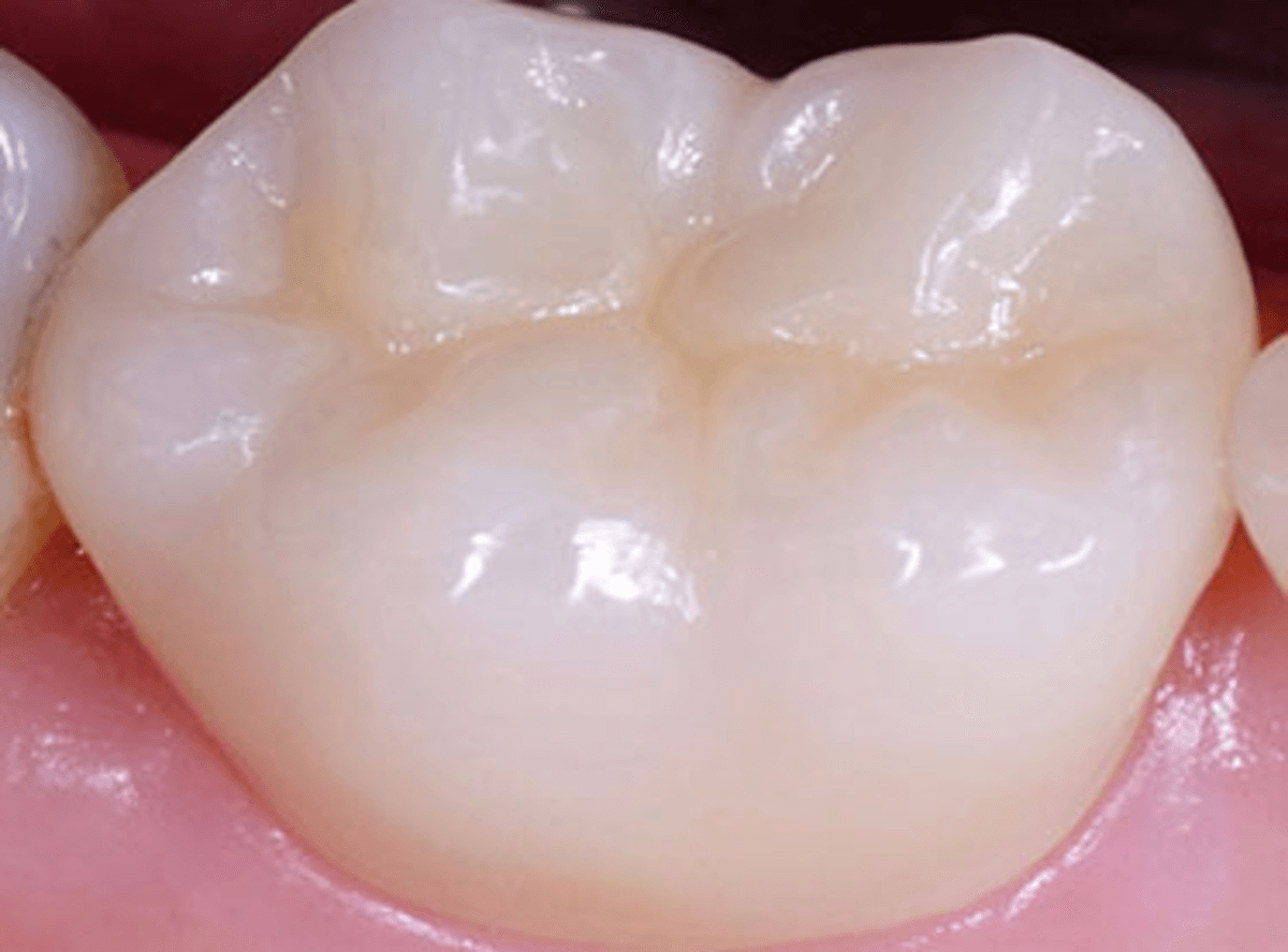 composite tooth filling near me