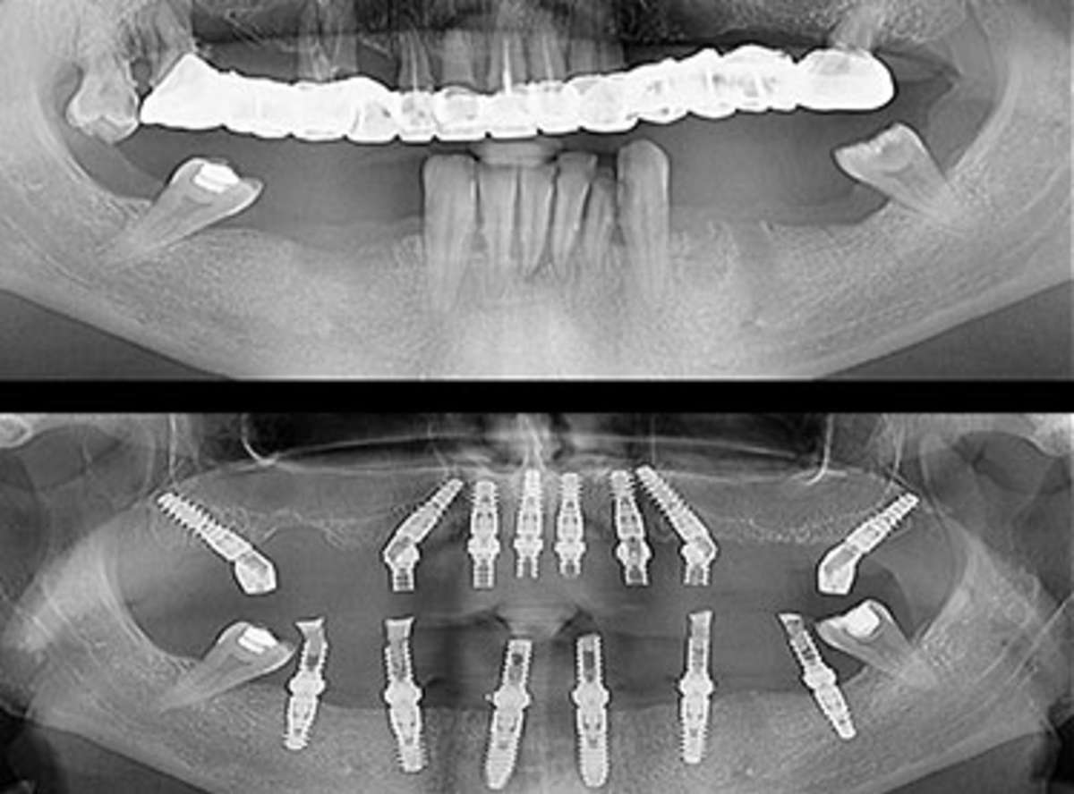 Zygoma Dental Implants near me
