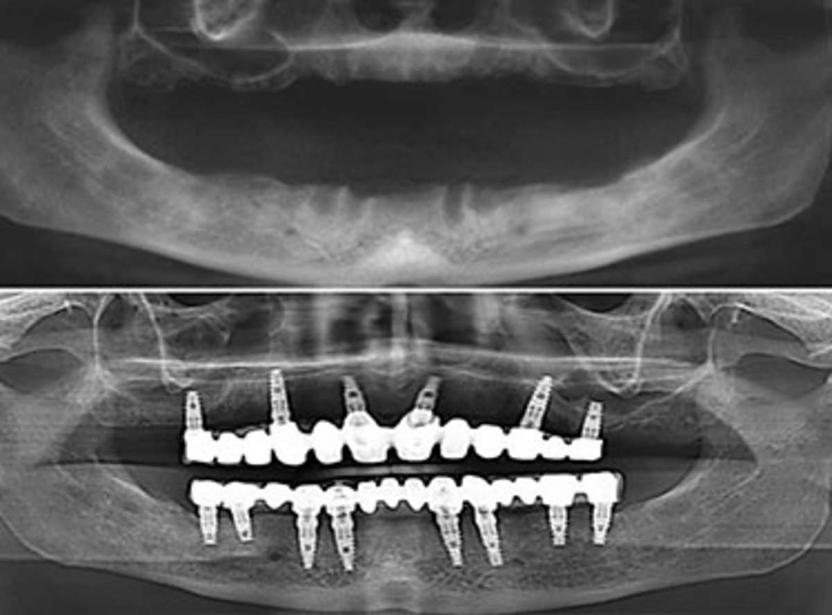 all on 6/8 Dental Implant near me in india