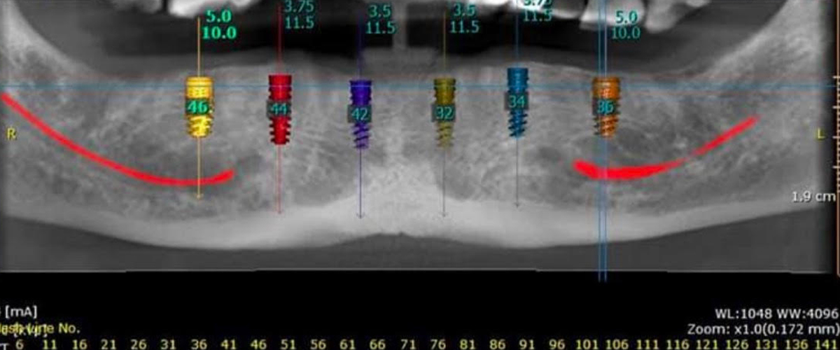 full mouth dental implants Procedure in india