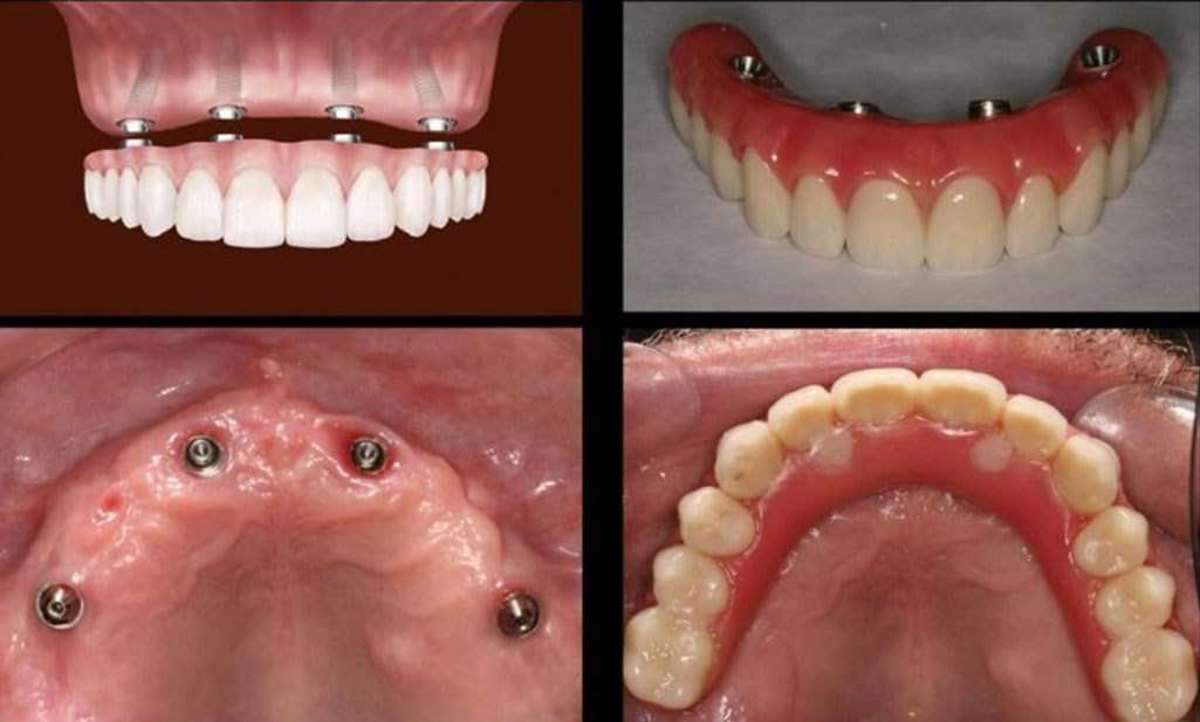 Procedure