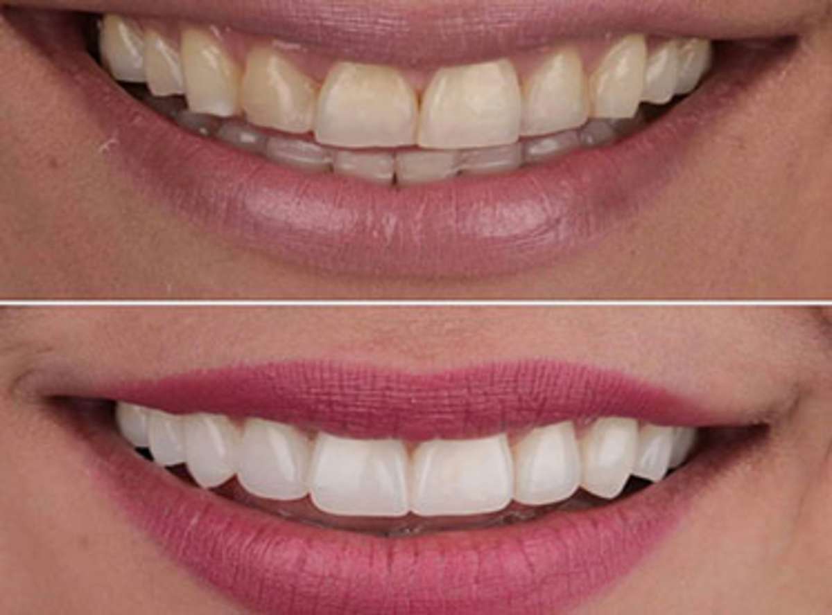 Porcelain Veneers near me