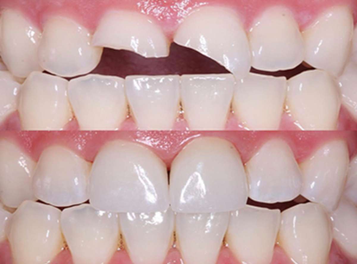 Tooth Fracture treatment