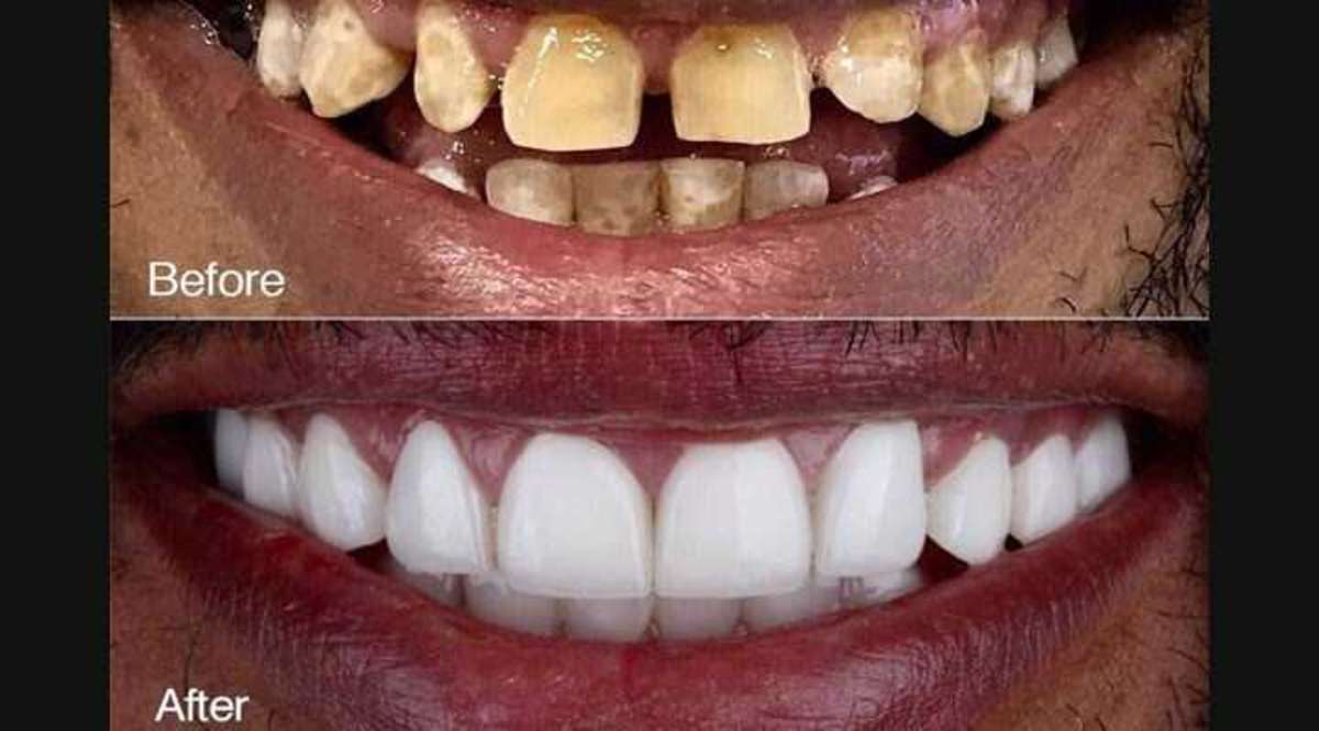 dental design smile Procedure in Delhi, smile makeovers