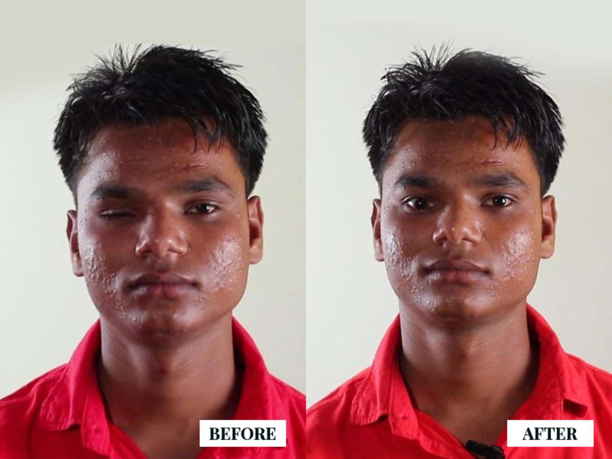 Prosthetic Eye (Ocular Prosthesis) surgery