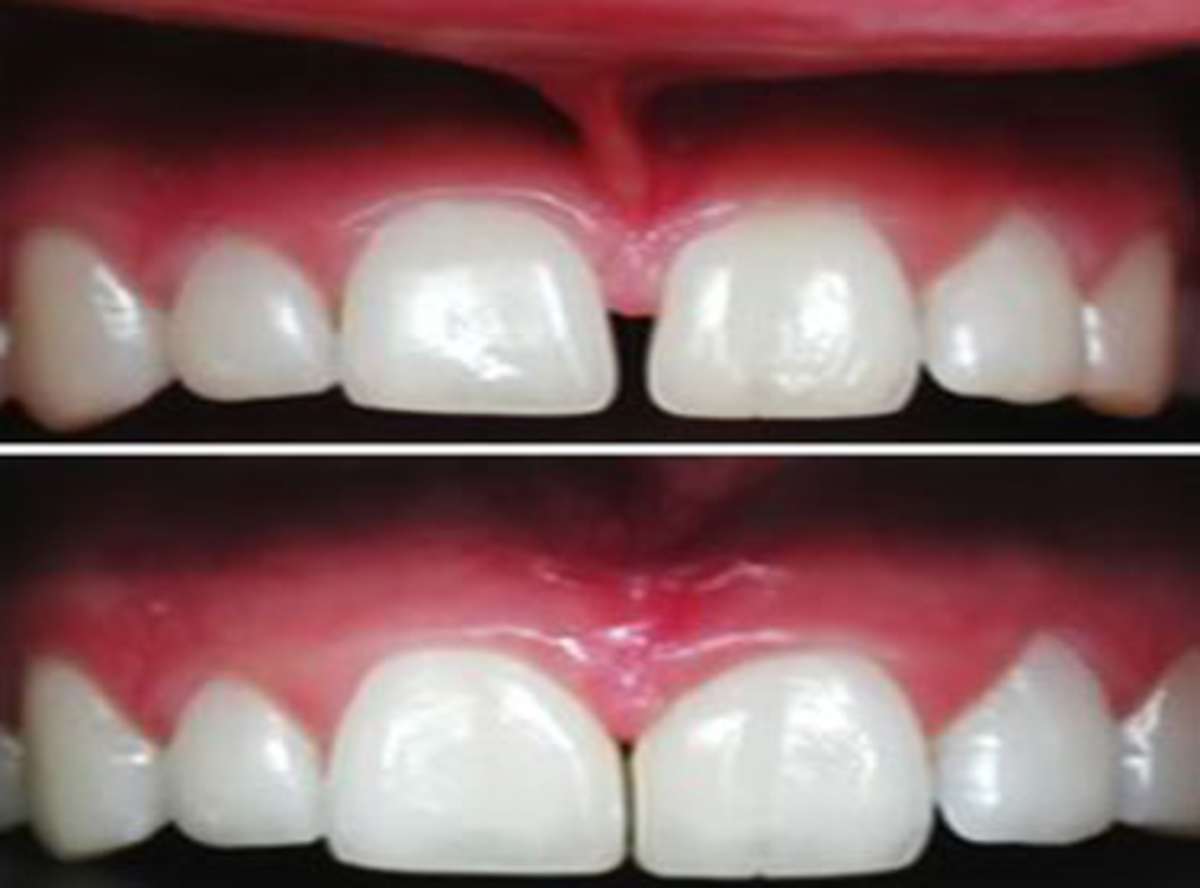Laser Frenectomy Surgery near me