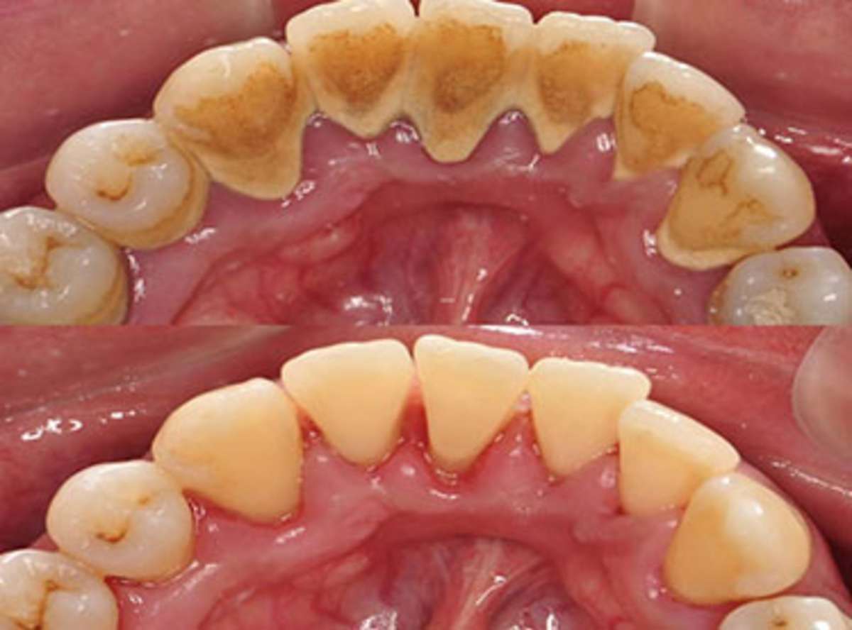 Periodontal Gum Flap Surgery near me