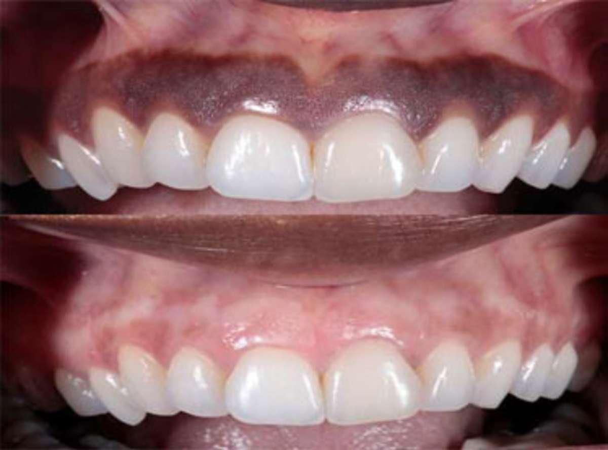LASER Gums Depigmentation near me