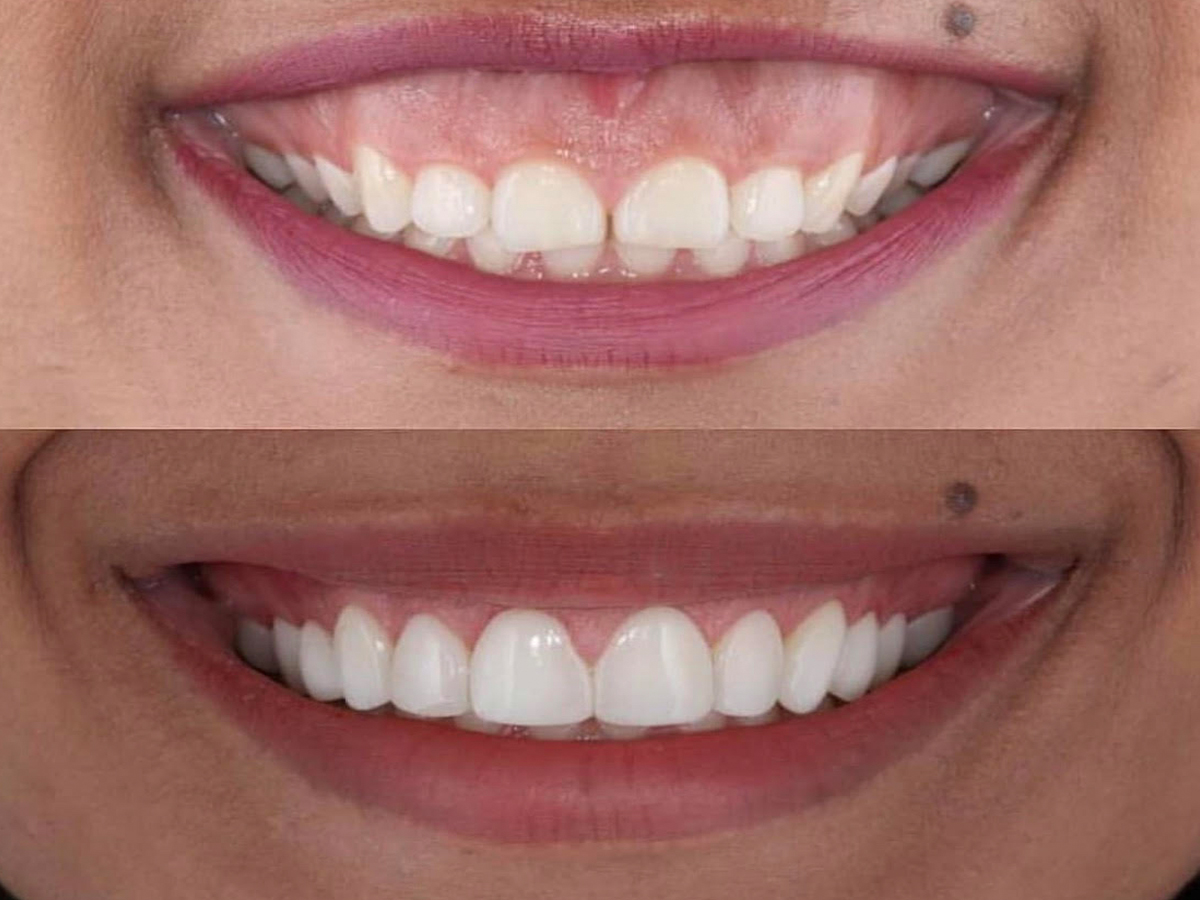 Gummy Smile Correction near me