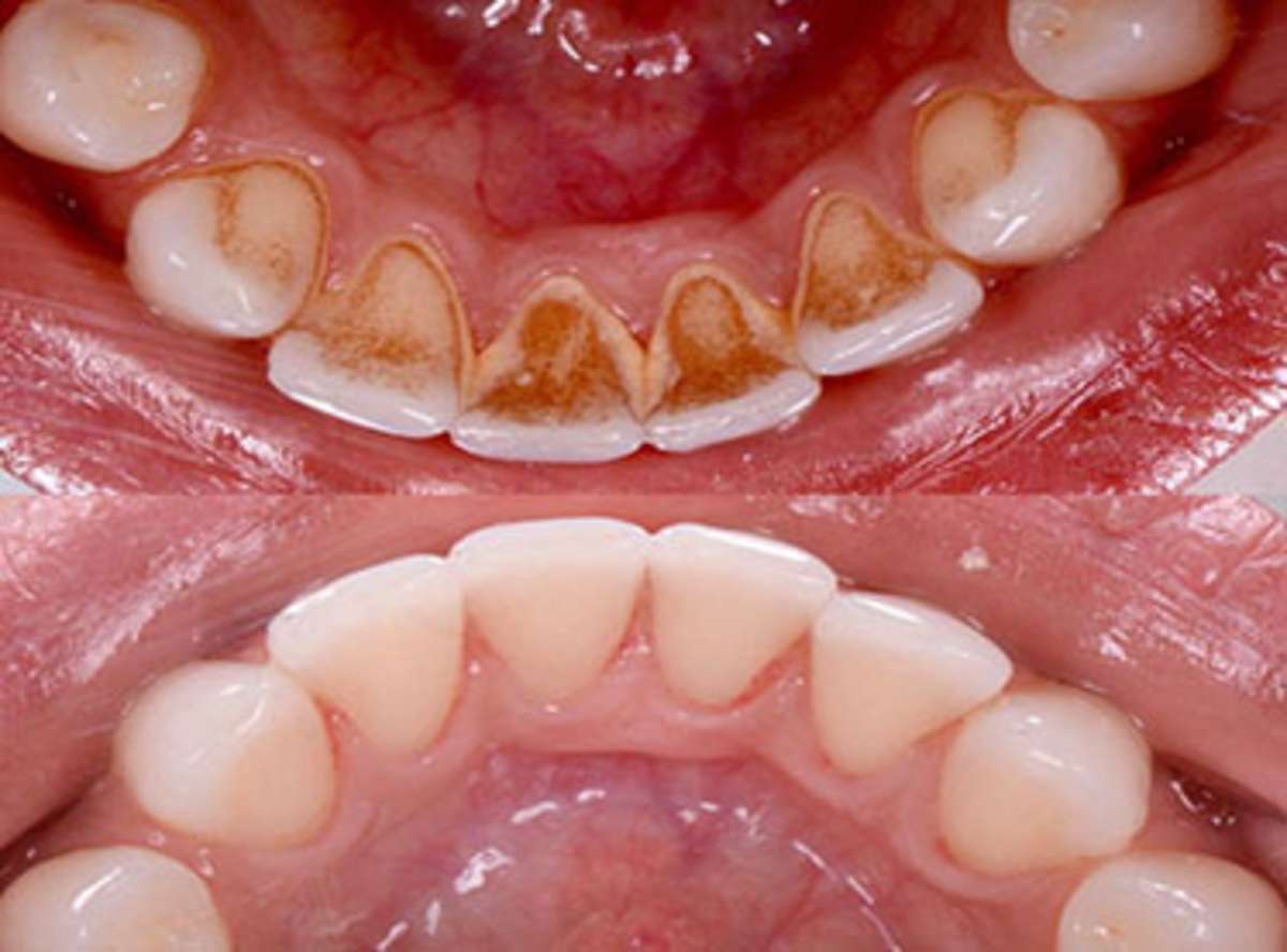 Bleeding gums/Gum Diseases treatment near me