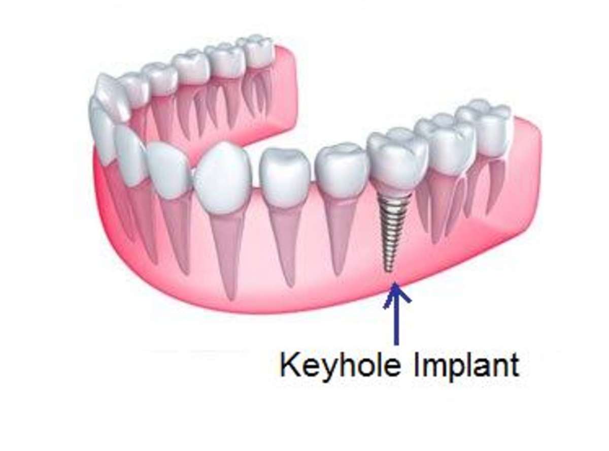 keyhole Dental Implant near me