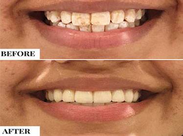 No drill dentistry near me