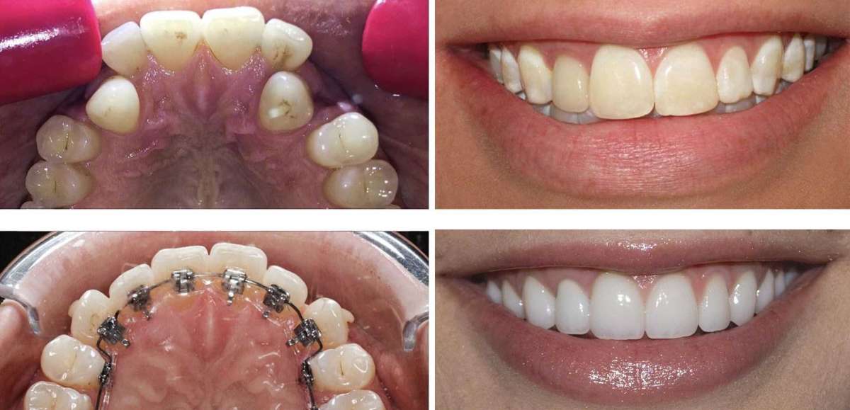 Dental Braces near me