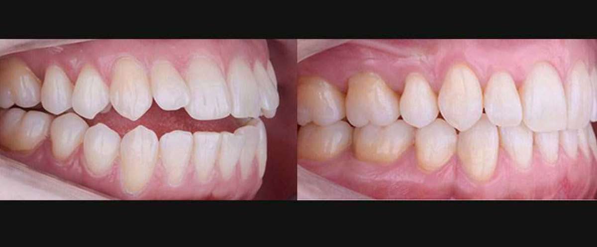 We are one of the best orthodontist dentist offering Fastest Teeth Braces Treatment with 3D Digital Orthodontic Treatment Planning located in south delhi and North delhi.