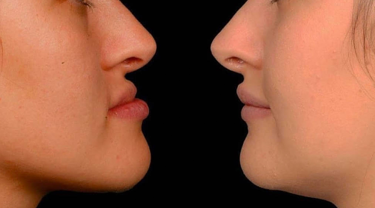 Surgical Orthodontics/Orthognathic Surgery near me