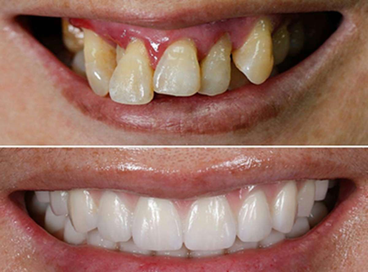 Mouth Sores/Canker Sores/Mouth Ulcers treatment near me