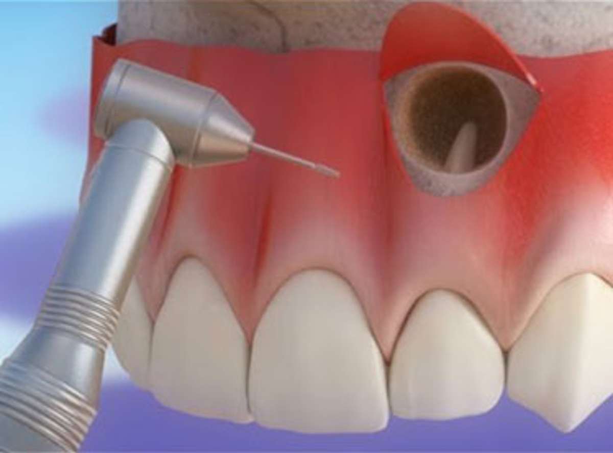 Tooth Root End Surgery near me