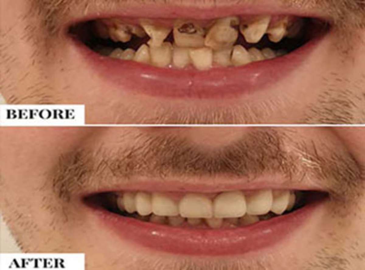 Malaligned/Crooked Teeth treatment near me
