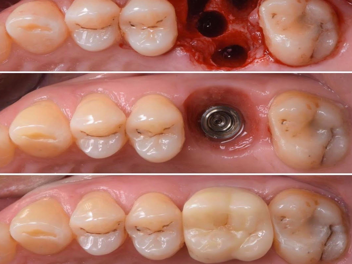 same day Dental Implants near me