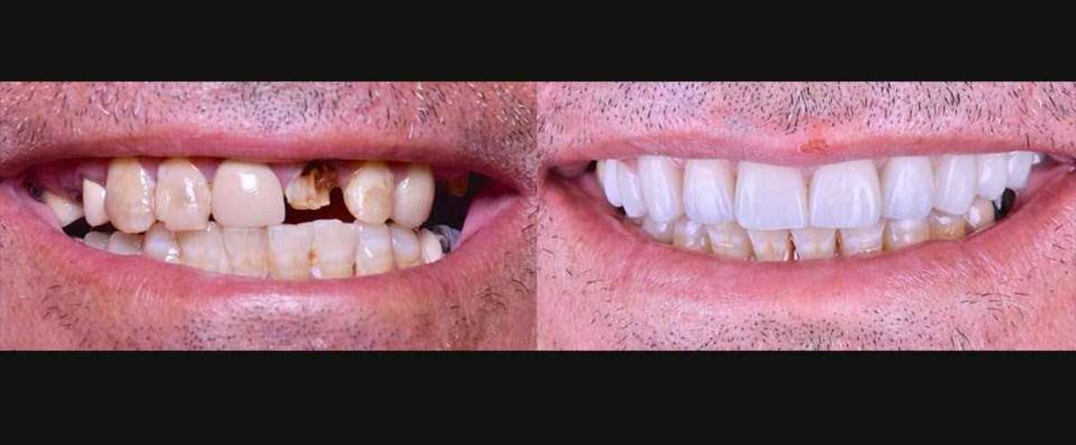smile makeover near me Procedure, smile designer