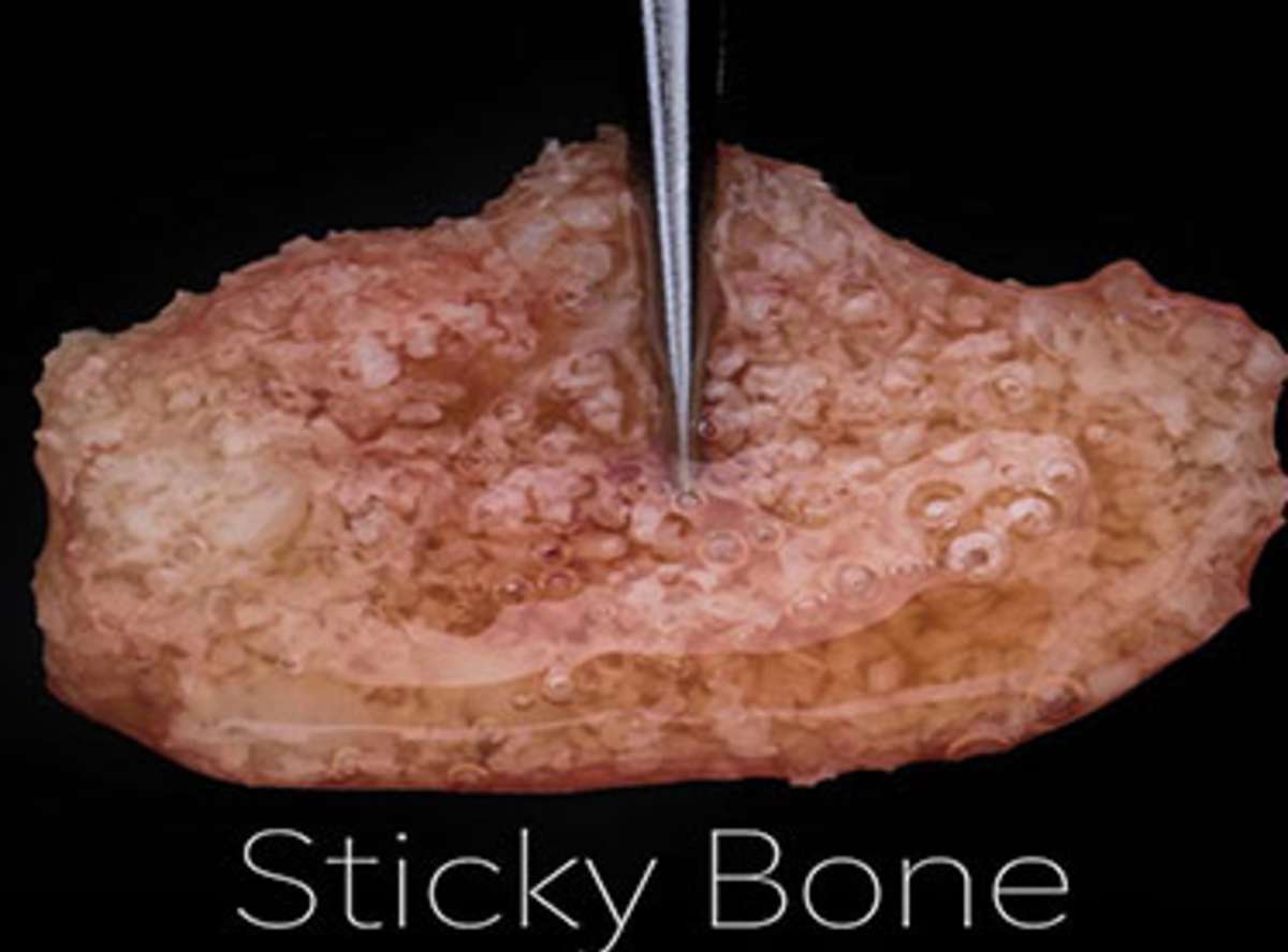 Soft Tissue Grafting