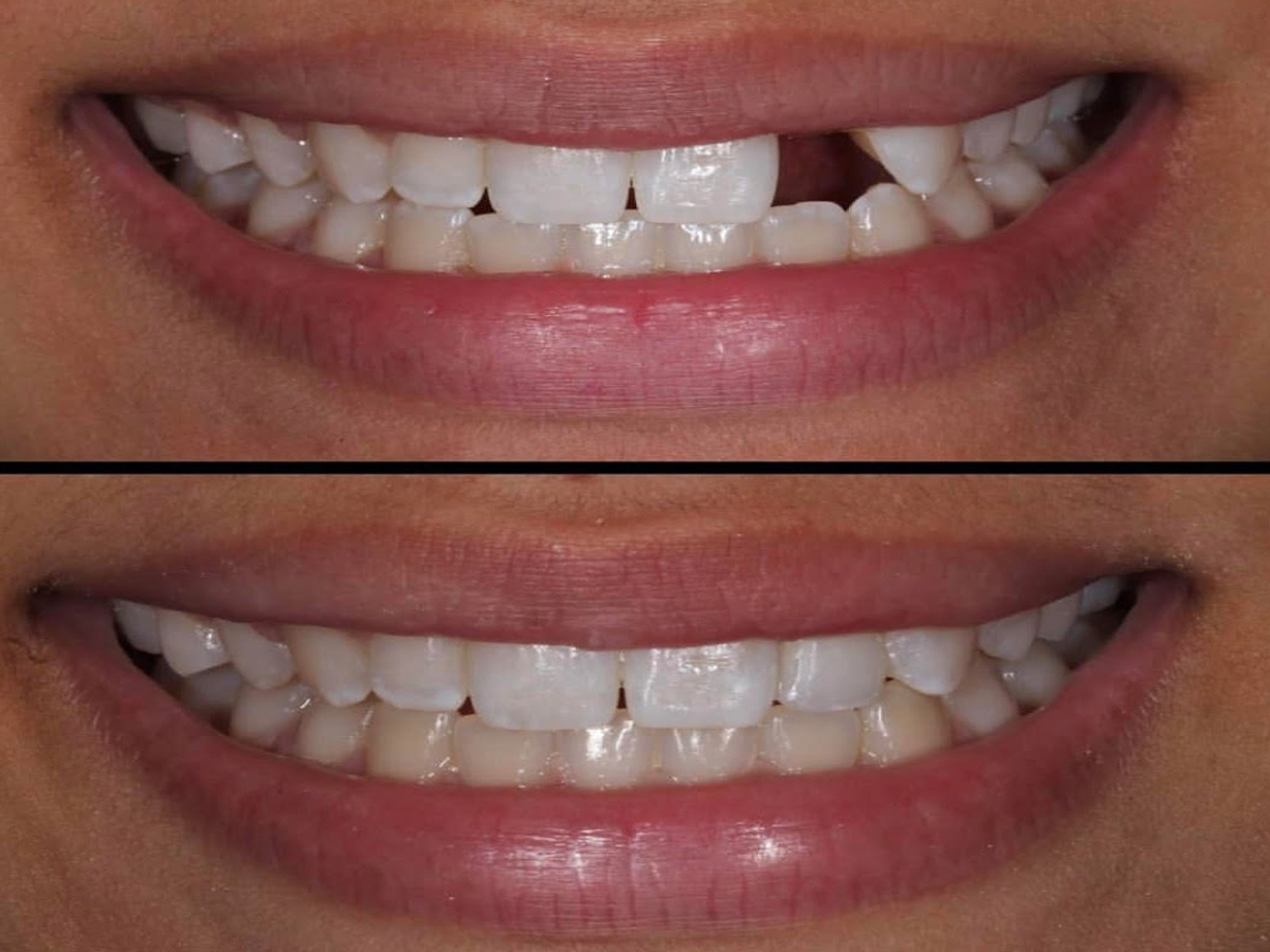 Teeth replacement in an Hour