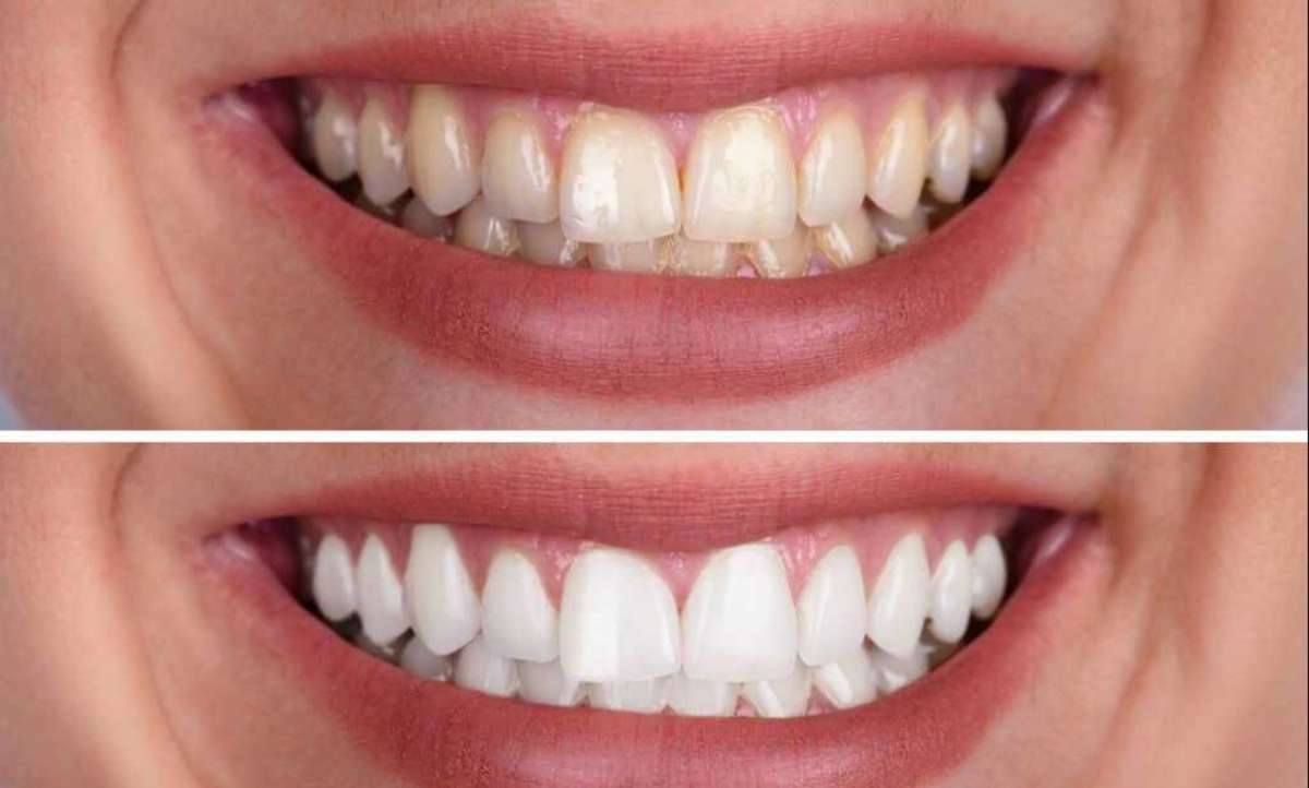 Ultradent Teeth Whitening near me
