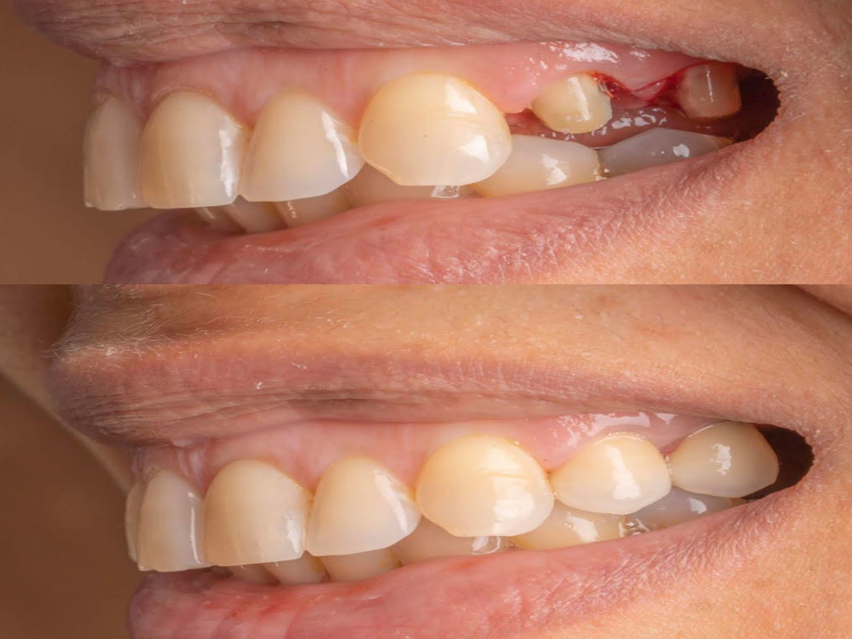Porcelain, Ceramic and Zirconia crowns near me, gold tooth cap