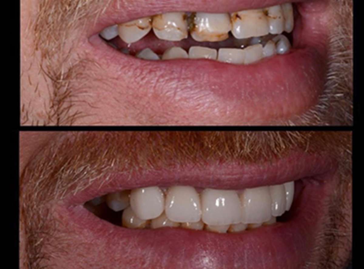 Bruxism (Teeth grinding) Treatment near me