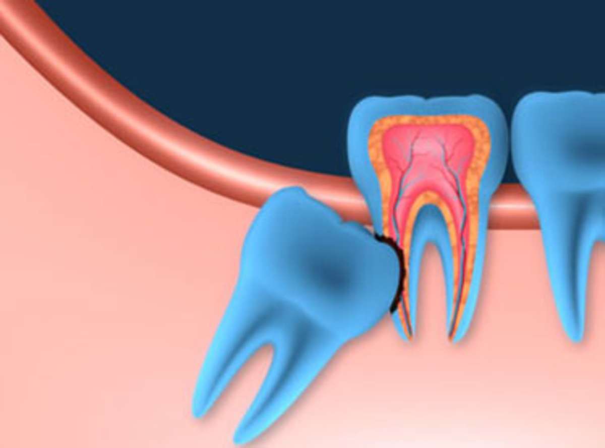 Wisdom Teeth Removal near me