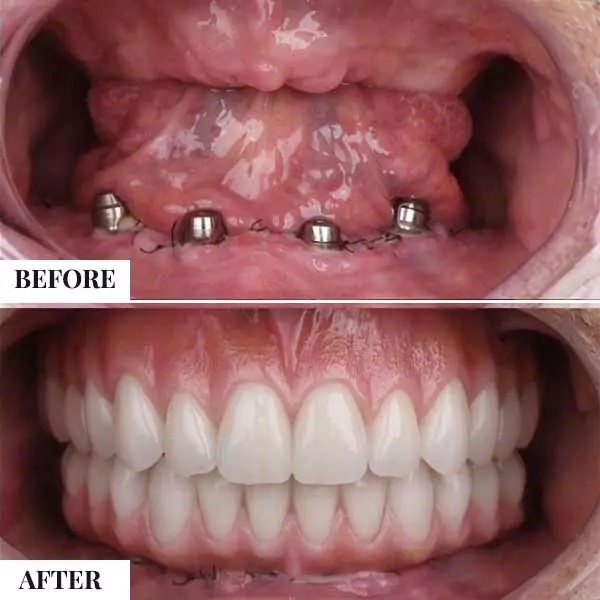 We are one of the best dental implantologist located in Pitampura, North Delhi for low cost and same day teeth implant easily approachable from Ashok Vihar, Netaji Subhash Place, Pitampura, Rohini, Punjab Bagh, Shalimar Bagh and rajouri Garden.