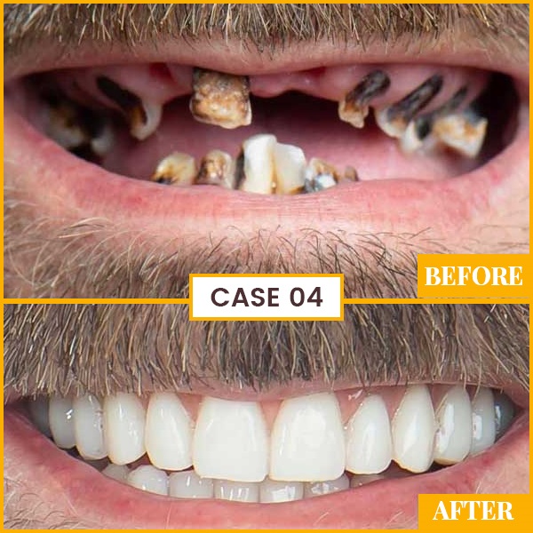 cost of full mouth teeth plantation in india