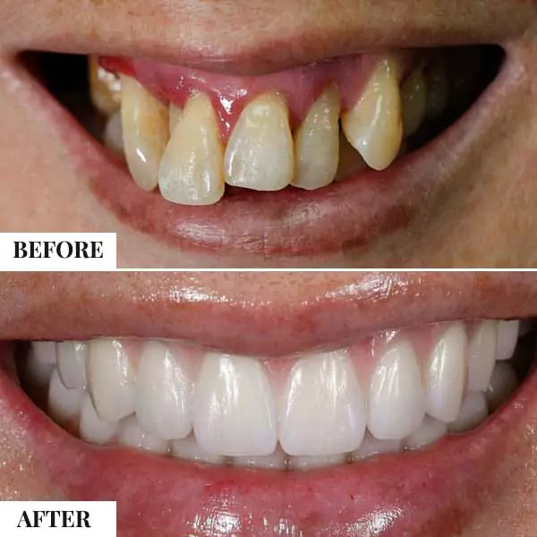 cost of full mouth teeth plantation in india