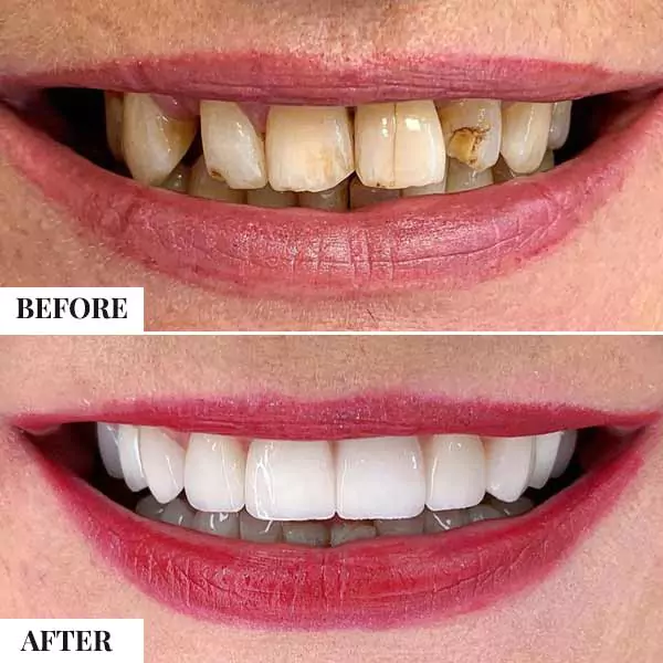 full mouth teeth transplant cost in india