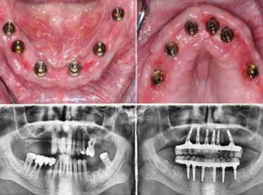 dental implants clinic in india