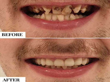 same day express dental treatments in india, best dentist in south delhi