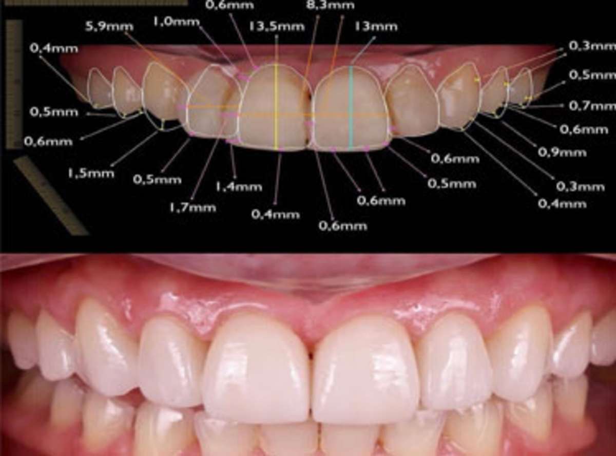3D Smile Designing in India