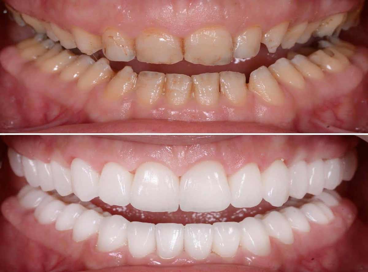 Full Mouth Rehabilitation treatment in india