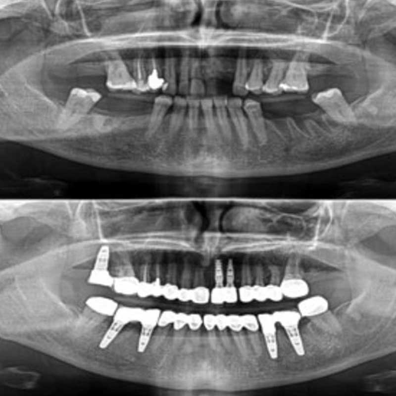 how much does it cost to get a full mouth of dental implants