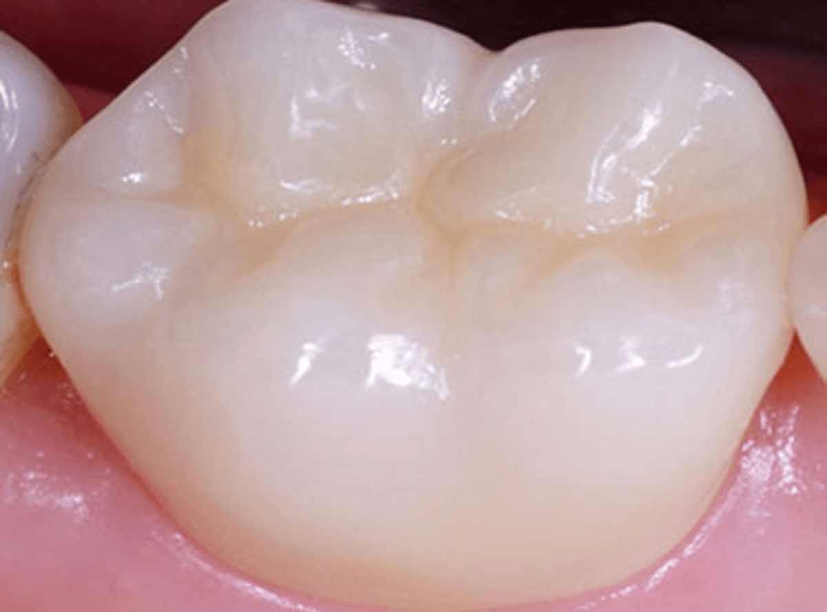 Tooth-colored composite fillings near me